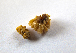 calcium oxalate kidney stones