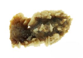 Struvite Kidney Stones