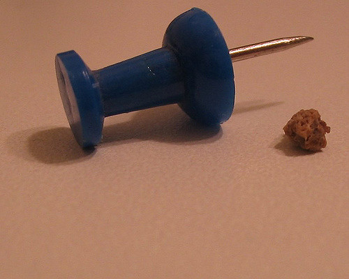 kidney stones