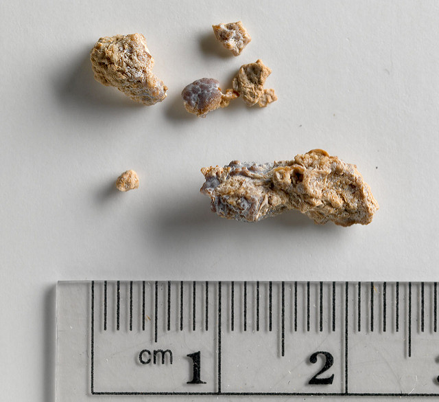 kidney stones